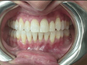 Before and after Invisalign results at Pearl Dental Group in Hilliard