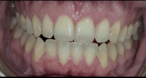 Before and after Invisalign results at Pearl Dental Group in Hilliard