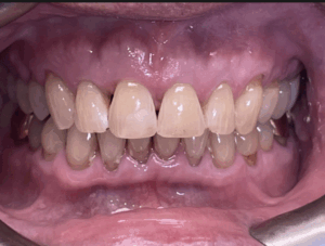 Before and after Invisalign results at Pearl Dental Group in Hilliard