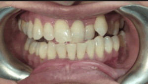 Before and after Invisalign results at Pearl Dental Group in Hilliard