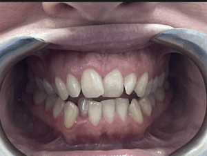 Before and after Invisalign results at Pearl Dental Group in Hilliard