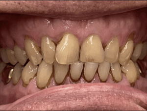 Before and after Invisalign results at Pearl Dental Group in Hilliard